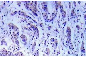 Immunohistochemistry (IHC) analyzes of ASK1 antibody in paraffin-embedded human breast carcinoma tissue. (ASK1 抗体)