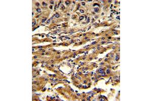 Formalin-fixed and paraffin-embedded human hepatocarcinoma reacted with ABCG1 Antibody (Center), which was peroxidase-conjugated to the secondary antibody, followed by DAB staining. (ABCG1 抗体  (AA 359-387))