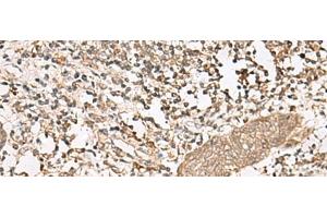 Immunohistochemistry of paraffin-embedded Human esophagus cancer tissue using FGF13 Polyclonal Antibody at dilution of 1:45(x200) (FGF13 抗体)
