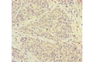 Immunohistochemistry of paraffin-embedded human ovarian cancer using ABIN7152525 at dilution of 1:100 (FOXRED1 抗体  (AA 307-486))