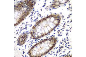 Immunohistochemistry of paraffin-embedded human colon using MSH6 antibody. (MSH6 抗体)