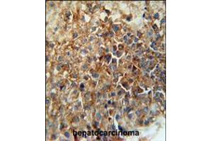 CD46 Antibody immunohistochemistry analysis in formalin fixed and paraffin embedded human hepatocarcinoma followed by peroxidase conjugation of the secondary antibody and DAB staining. (CD46 抗体  (C-Term))