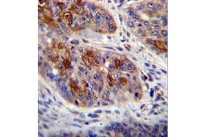 Imunohistochemistry analysis in formalin fixed and paraffin embedded human esophageal carcinoma reacted with HAX1 Antibody (C-term) followed by peroxidase conjugation of the secondary antibody and DAB staining. (HAX1 抗体  (C-Term))