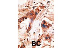 Formalin-fixed and paraffin-embedded human cancer tissue reacted with BMP2K polyclonal antibody  , which was peroxidase-conjugated to the secondary antibody, followed by AEC staining. (BMP2K 抗体  (Internal Region))