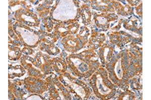 The image on the left is immunohistochemistry of paraffin-embedded Human thyroid cancer tissue using ABIN7130296(MTMR7 Antibody) at dilution 1/40, on the right is treated with fusion protein. (MTMR7 抗体)