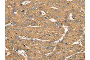 The image on the left is immunohistochemistry of paraffin-embedded Human liver cancer tissue using ABIN7192541(SLIT1 Antibody) at dilution 1/35, on the right is treated with synthetic peptide. (SLIT1 抗体)