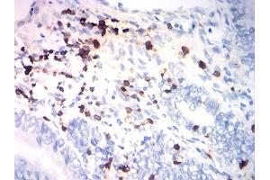 Immunohistochemical analysis of paraffin-embedded endometrial cancer tissues using CD7 mouse mAb with DAB staining. (CD7 抗体  (AA 26-180))