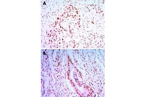 Immunohistochemical analysis of paraffin-embedded human lung cancer tissues (A) and colon cancer tissues (B) using CDC27 monoclonal antibody, clone 5C12  with DAB staining.