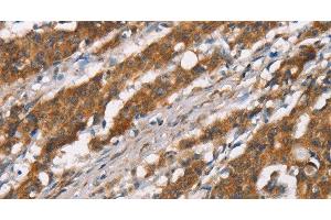 Immunohistochemistry of paraffin-embedded Human gasrtic cancer tissue using DSC2 Polyclonal Antibody at dilution 1:35 (Desmocollin 2 抗体)