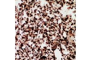 Immunohistochemical analysis of ZNF600 staining in human lung cancer formalin fixed paraffin embedded tissue section. (ZNF600 抗体)