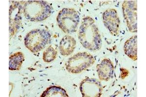 Immunohistochemistry of paraffin-embedded human breast cancer using ABIN7151101 at dilution of 1:100 (Pellino 1 抗体  (AA 1-250))
