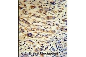 A1BG Antibody (C-term) (R) IHC analysis in formalin fixed and paraffin embedded human breast carcinoma tissue followed by peroxidase conjugation of the secondary antibody and DAB staining. (A1BG 抗体  (C-Term))