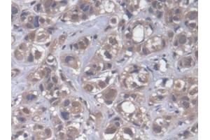 DAB staining on IHC-P; Samples: Human Breast cancer Tissue (CPEB1 抗体  (AA 311-561))