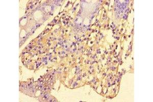 Immunohistochemistry of paraffin-embedded human colon cancer using ABIN7169823 at dilution of 1:100 (SLIT-ROBO rho GTPase Activating Protein 2C (SRGAP2C) (AA 1-242) 抗体)