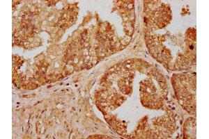 IHC image of ABIN7166823 diluted at 1:200 and staining in paraffin-embedded human prostate cancer performed on a Leica BondTM system. (C14ORF177 抗体  (AA 1-125))