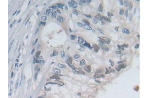 Detection of SELP in Human Colorectal cancer Tissue using Polyclonal Antibody to P-Selectin (SELP)
