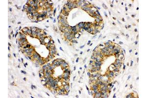Anti- ITGA2B Picoband antibody, IHC(P) IHC(P): Human Mammary Cancer Tissue (Integrin Alpha2b 抗体  (C-Term))