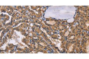 Immunohistochemistry of paraffin-embedded Human thyroid cancer tissue using EPHB6 Polyclonal Antibody at dilution 1:50 (EPH Receptor B6 抗体)