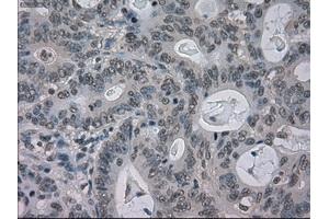 Immunohistochemical staining of paraffin-embedded Carcinoma of liver tissue using anti-BUB1Bmouse monoclonal antibody. (BUB1B 抗体)