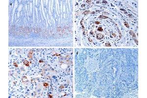 Immunohistochemical analysis of EPHB1 in human gastric cancer tissues. (EPH Receptor B1 抗体  (C-Term))