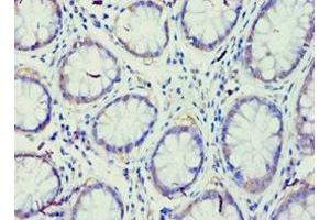 Immunohistochemistry of paraffin-embedded human colon cancer using ABIN7167947 at dilution of 1:100 (GRAF 抗体  (AA 625-814))