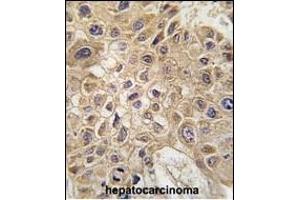Formalin-fixed and paraffin-embedded human hepatocarcinoma tissue reacted with FR Antibody (C-term) (ABIN388938 and ABIN2850529) , which was peroxidase-conjugated to the secondary antibody, followed by DAB staining.
