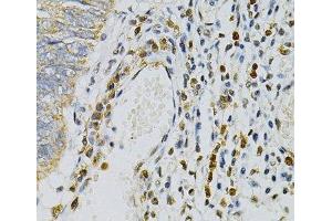 Immunohistochemistry of paraffin-embedded Human colon carcinoma using CDA Polyclonal Antibody at dilution of 1:100 (40x lens). (CDA 抗体)