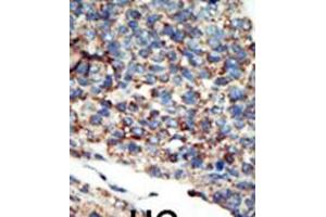 Formalin-fixed and paraffin-embedded human cancer tissue reacted with the primary antibody, which was peroxidase-conjugated to the secondary antibody, followed by AEC staining. (PI3KC2G 抗体  (N-Term))