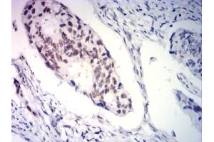Immunohistochemical analysis of paraffin-embedded rectal cancer tissues using PGR mouse mAb with DAB staining. (Progesterone Receptor 抗体  (AA 166-411))