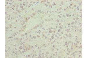 Immunohistochemistry of paraffin-embedded human liver cancer using ABIN7144721 at dilution of 1:100 (ASNSD1 抗体  (AA 258-357))