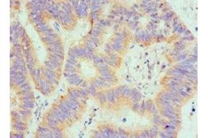 Immunohistochemistry of paraffin-embedded human colon cancer using ABIN7168895 at dilution of 1:100 (SPTLC1 抗体  (AA 37-310))