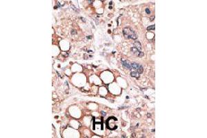 Formalin-fixed and paraffin-embedded human hepatocellular carcinoma tissue reacted with FOXO4 polyclonal antibody  , which was peroxidase-conjugated to the secondary antibody, followed by AEC staining. (FOXO4 抗体  (N-Term))