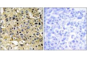 Immunohistochemistry analysis of paraffin-embedded human breast carcinoma tissue, using ENTK Antibody. (TMPRSS15 抗体  (AA 81-130))