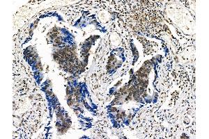 Phospho-n-Myc (Ser261/Ser263) Antibody at 1/100 staining Human colorectal cancer by IHC-P. (MYCN 抗体  (pSer261, pSer263))