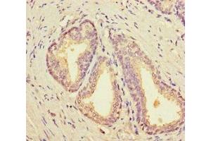 Immunohistochemistry of paraffin-embedded human prostate cancer using ABIN7161699 at dilution of 1:100 (SCP2 抗体  (AA 1-143))