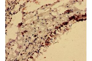 Immunohistochemistry analysis of human lung cancer using ABIN7153105 at dilution of 1:100 (FOXR2 抗体  (AA 1-300))