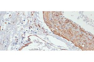 Immunohistochemistry of paraffin-embedded Human gastric cancer using Phospho-MYL9(T18/S19) Polyclonal Antibody at dilution of 1:100 (40x lens). (MYL9 抗体  (pSer19, pThr18))