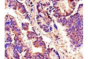Immunohistochemistry of paraffin-embedded human colon cancer using ABIN7142915 at dilution of 1:100
