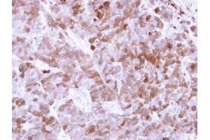 IHC-P Image Immunohistochemical analysis of paraffin-embedded H520 xenograft, using Factor XIIIa, antibody at 1:500 dilution.