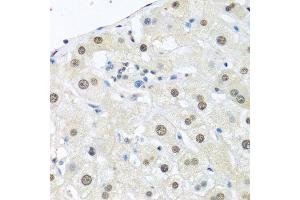 Immunohistochemistry of paraffin-embedded human breast carcinoma using UBC antibody. (UBC 抗体  (AA 1-100))