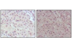 Immunohistochemical analysis of paraffin-embedded human lung cancer (left) and esophagus cancer (right), showing nuclear weak staining with DAB staining using MLL mouse mAb. (MLL/KMT2A 抗体  (AA 3751-3968))