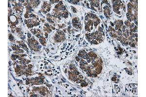 Immunohistochemical staining of paraffin-embedded Carcinoma of liver tissue using anti-ATP5B mouse monoclonal antibody. (ATP5B 抗体)