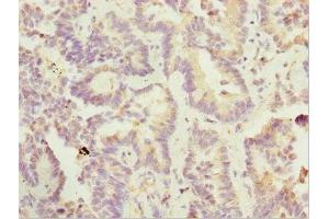 Immunohistochemistry of paraffin-embedded human lung cancer using ABIN7169185 at dilution of 1:100 (SIK3 抗体  (AA 60-310))