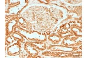 IHC testing of FFPE human renal cell carcinoma with Calnexin antibody. (Calnexin 抗体)