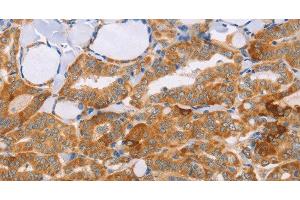 Immunohistochemistry of paraffin-embedded Human thyroid cancer tissue using CARD6 Polyclonal Antibody at dilution 1:60 (CARD6 抗体)