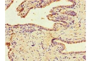 Immunohistochemistry of paraffin-embedded human prostate cancer using ABIN7159790 at dilution of 1:100 (MAST1 抗体  (AA 687-879))
