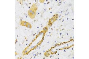 Immunohistochemistry of paraffin-embedded human liver cancer using KIF1B Antibody (ABIN2563552) at dilution of 1:100 (40x lens). (KIF1B 抗体)