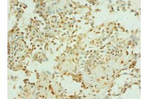 Immunohistochemistry of paraffin-embedded human breast cancer using  at dilution of 1: 100 (TEP1 抗体  (AA 2-226))