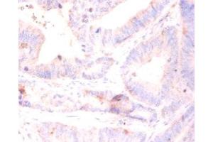 Immunohistochemistry of paraffin-embedded human colon cancer using ABIN7142829 at diluton of 1:50 (RPL5 抗体  (AA 2-297))