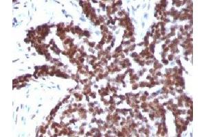 Formalin-fixed, paraffin-embedded human ovarian carcinoma stained with Cyclin B1 antibody. (Cyclin B1 抗体)